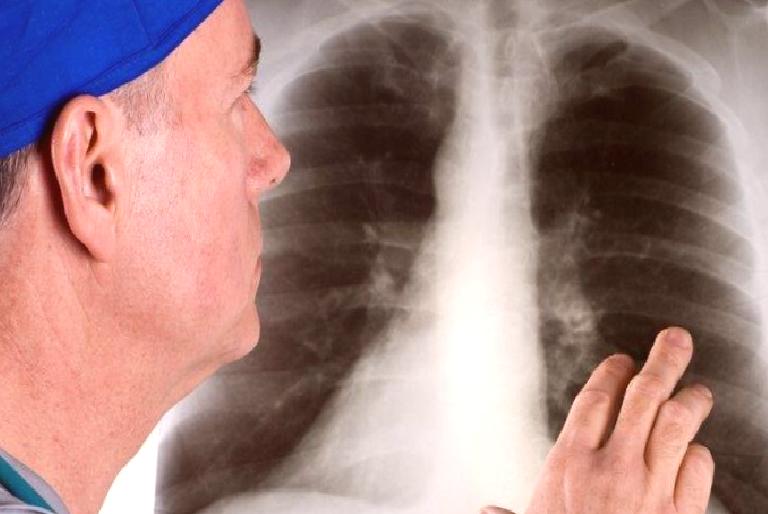 “Her Yıl 1.8 Milyon İnsan Akciğer Kanserinden Ölüyor”