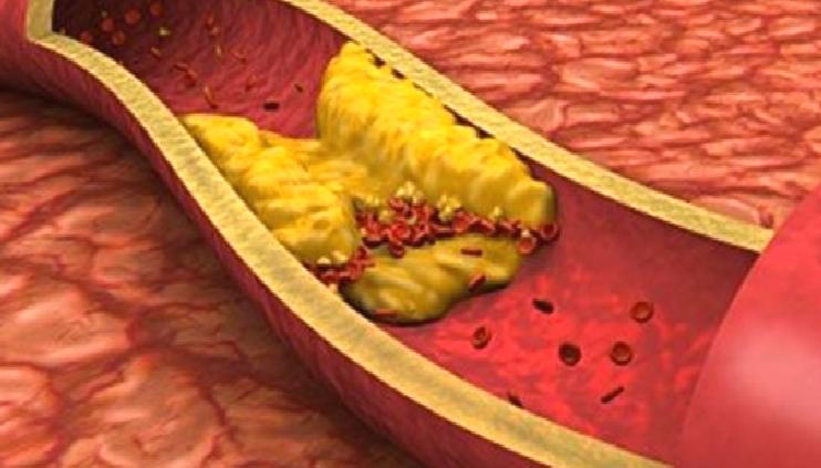 Kolesterol yüksekliği neden olur?.. İyi-kötü kolesterol nedir? (HDL-LDL nedir, iyi-kötü kolesterol farkı)