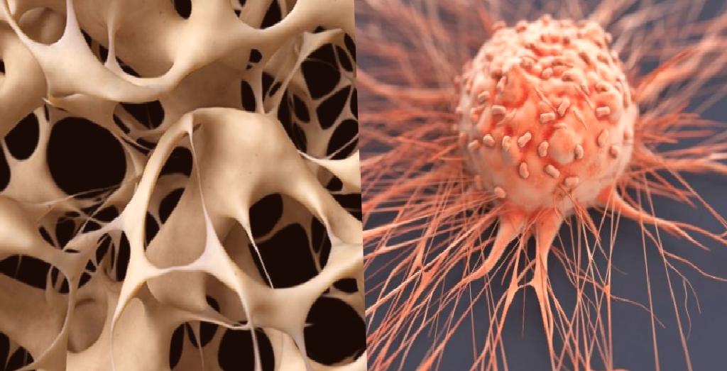 Osteoporoz ve Kanser Bağlantısı