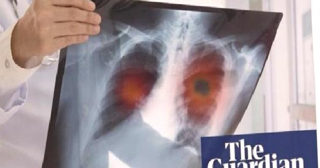 Prof. Dr. Sönmez ‘Akciğer Kanseri Hapı’ Araştırma Sonucunu Paylaştı!