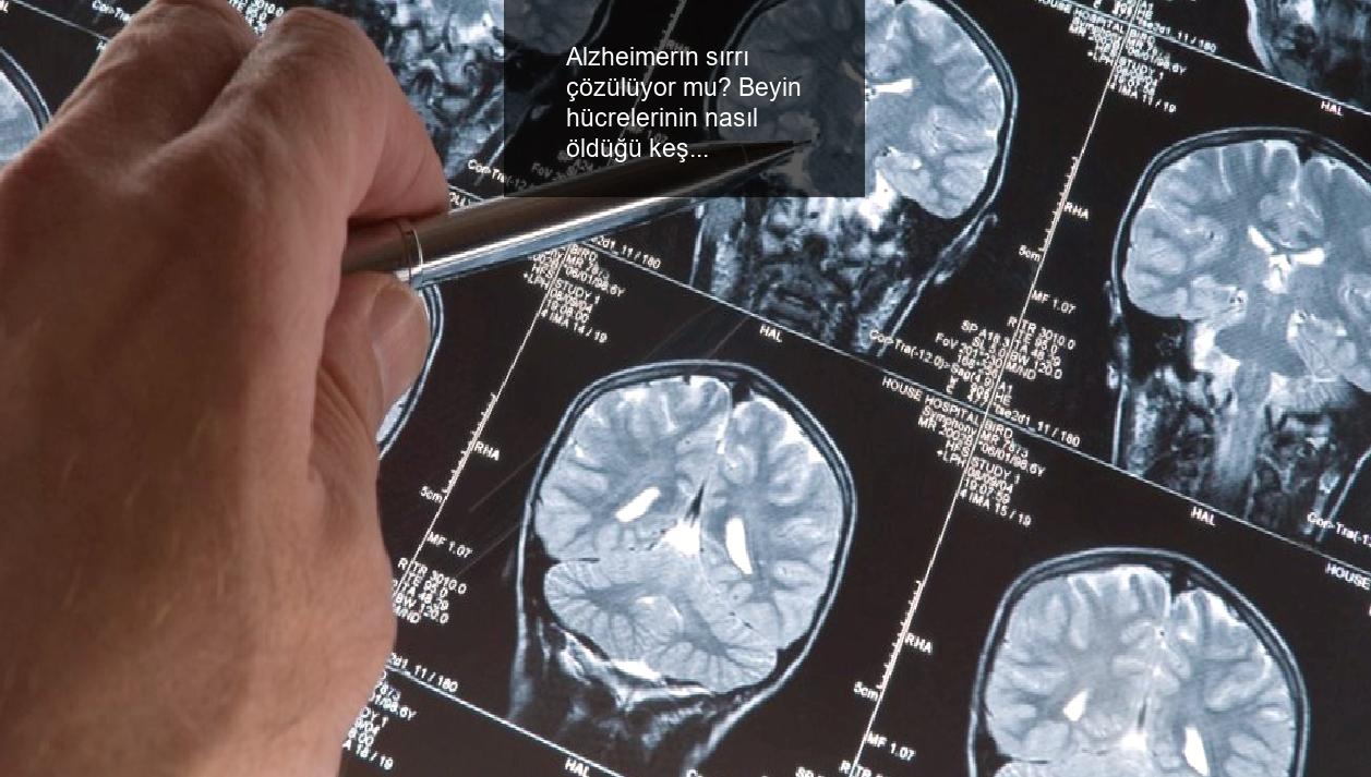 Alzheimerın sırrı çözülüyor mu? Beyin hücrelerinin nasıl öldüğü keşfedilmiş olabilir
