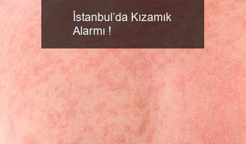 İstanbul’da Kızamık Alarmı !