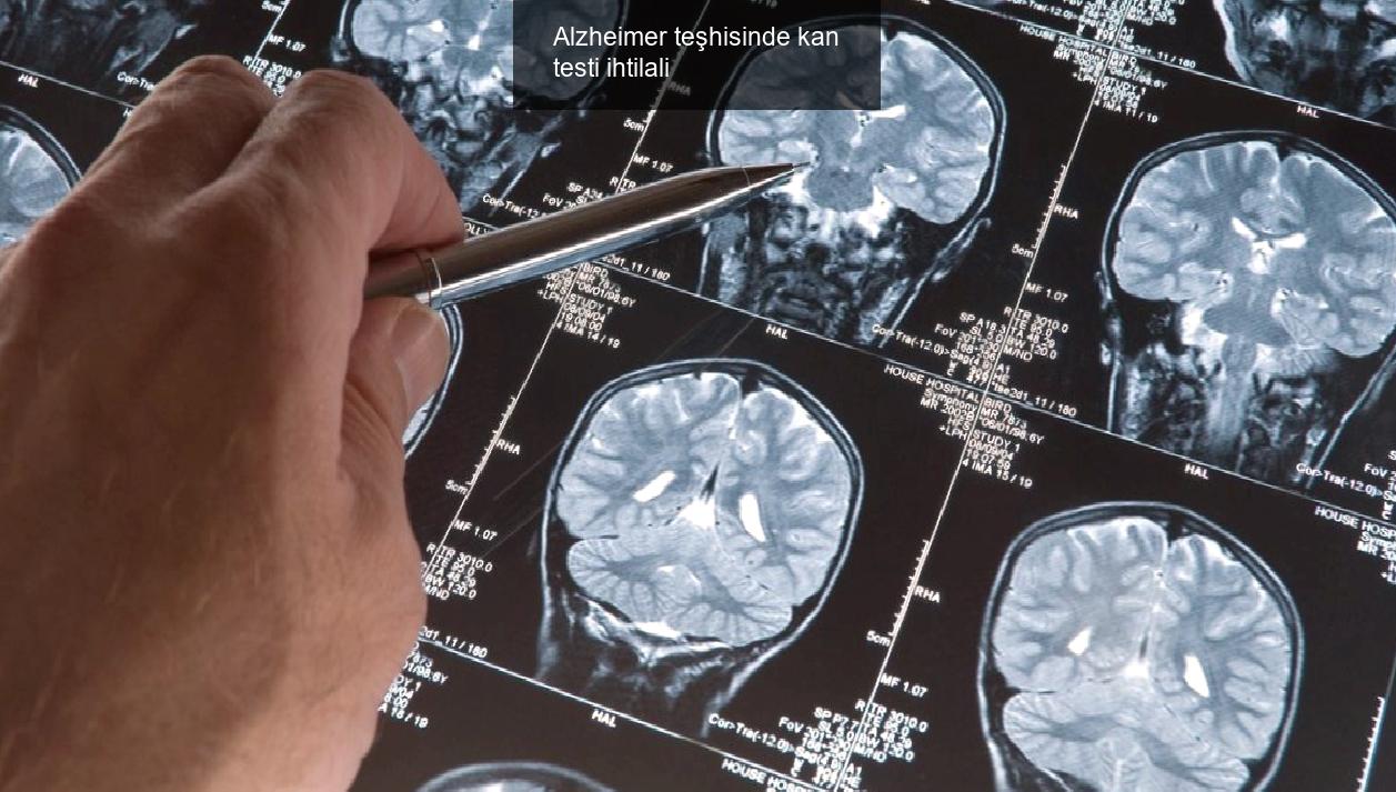 Alzheimer teşhisinde kan testi ihtilali