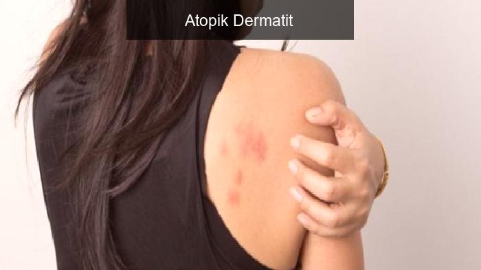Atopik Dermatit