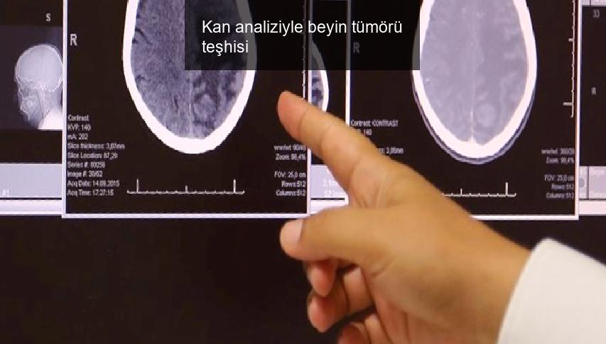 Kan analiziyle beyin tümörü teşhisi